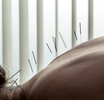 What is Acupuncture and How Does it Work?