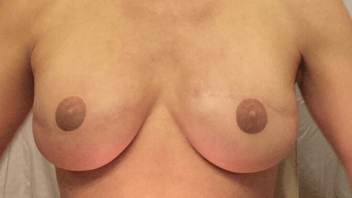 OLIVE - Temporary Nipple Tattoos for Mastectomy Restoration