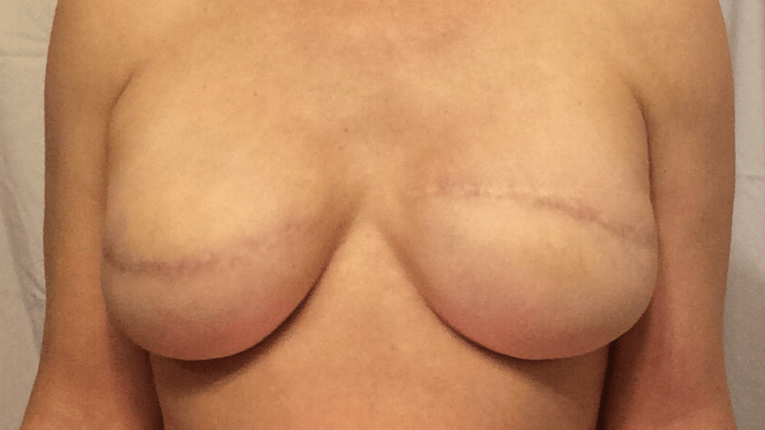 SIENNA – Temporary Nipple Tattoos for Mastectomy Restoration