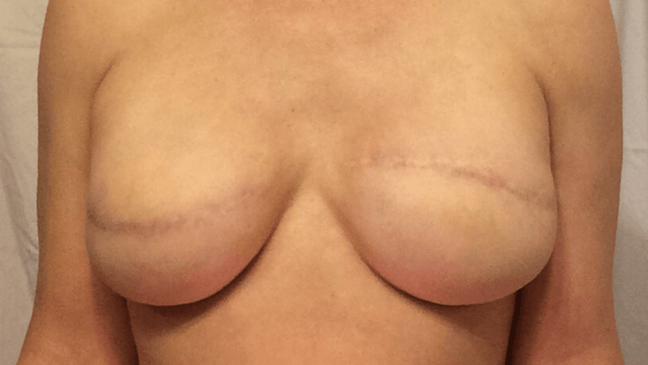 SIENNA – Temporary Nipple Tattoos for Mastectomy Restoration